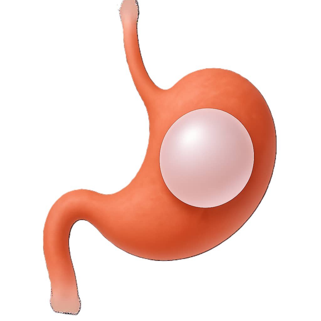 Balón Intragástrico No Ajustable